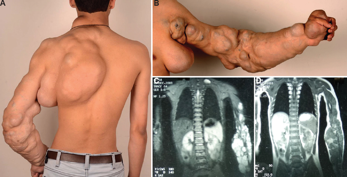 Kaposiform haemangioendothelioma with Kasabach - Merritt phenomenon